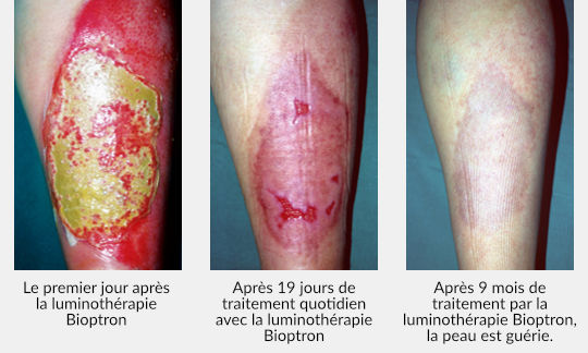 Zepter-Bioptron-wounds